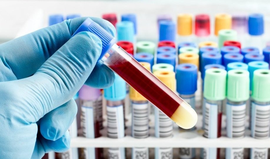 Xét nghiệm đông máu là một loại xét nghiệm huyết học phổ biến