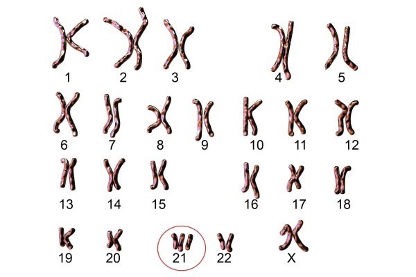 Đột biến ở nhiễm sắc thể 21 gây ra Hội chứng Down