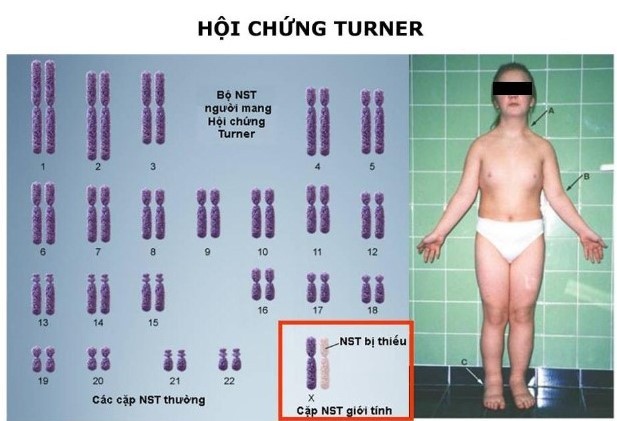 Hội chứng Turner do thiếu hoàn toàn hoặc một phần nhiễm sắc thể giới tính