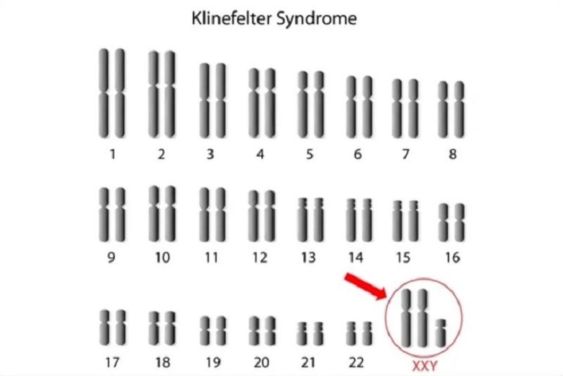 Hội chứng Klinefelter là rối loạn di truyền xảy ra ở nam giới với thêm 1 nhiễm sắc thể X
