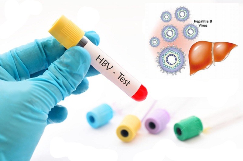 Xét nghiệm viêm gan B giúp phát hiện sớm và điều trị kịp thời bệnh viêm gan siêu vi B