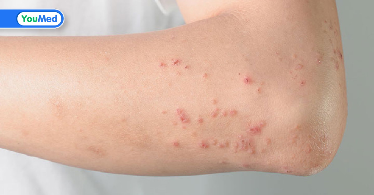 Giải đáp nổi mụn nước khắp người là bệnh gì? YouMed