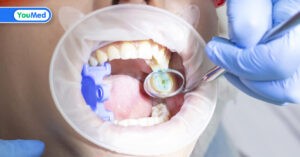 Bác sĩ giải đáp: Răng khôn bị sâu có nên nhổ không?