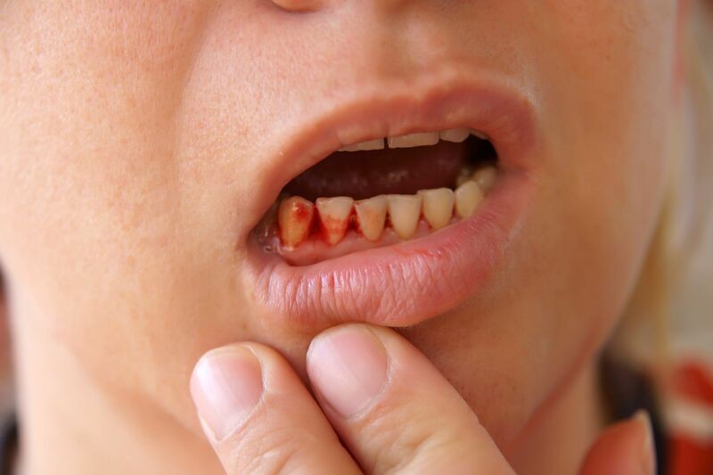 Sản phẩm Vitamin C 500 mg Healthy Care có thể hỗ trợ vấn đề chảy máu chân răng