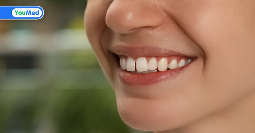 Răng thưa làm thế nào để khắc phục?