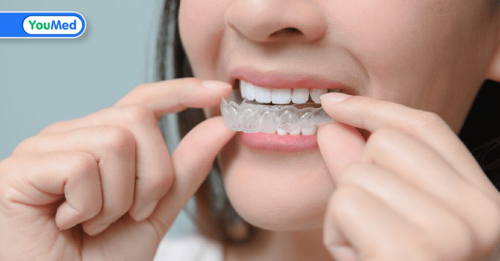 Niềng răng Invisalign là gì? Có nên lựa chọn không?