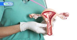 Các giai đoạn ung thư cổ tử cung: Đặc điểm và cách điều trị