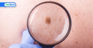 Nguyên nhân ung thư da và cách phòng ngừa hiệu quả