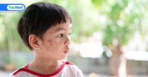 Thủy đậu kiêng gì và nên làm gì để mau khỏi bệnh?