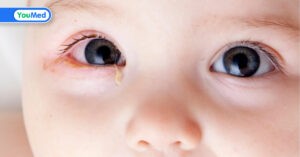 Đau mắt đỏ ở trẻ em: Dấu hiệu, nguyên nhân, cách điều trị và phòng ngừa