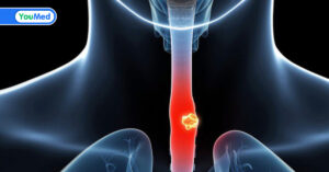 Các loại thuốc điều trị ung thư thực quản phổ biến hiện nay