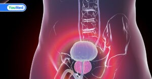 Ung thư tuyến tiền liệt di căn xương: Triệu chứng và cách điều trị